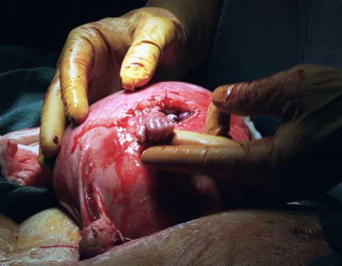 Baby holing doctors hand out of the womb, abortion perspective