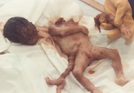 aborted baby, decapitated baby, right to life, horror of abortion